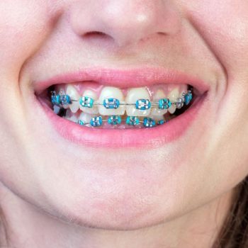 Kobieta nosi aparat ortodontyczny na zębach. Jak one działają?